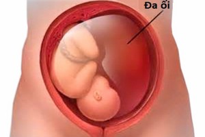 day ron, day ron quan co thai nhi, day ron thai nhi, hien tuong day ron quan co thai nhi, thai nhi